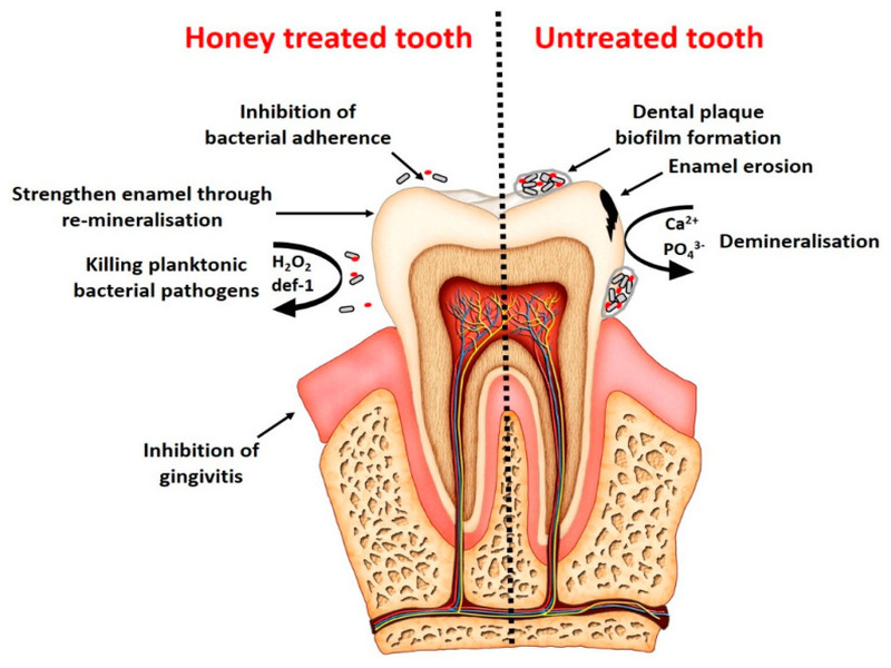 Honey treated toothache